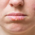 Lip Rash Treatment