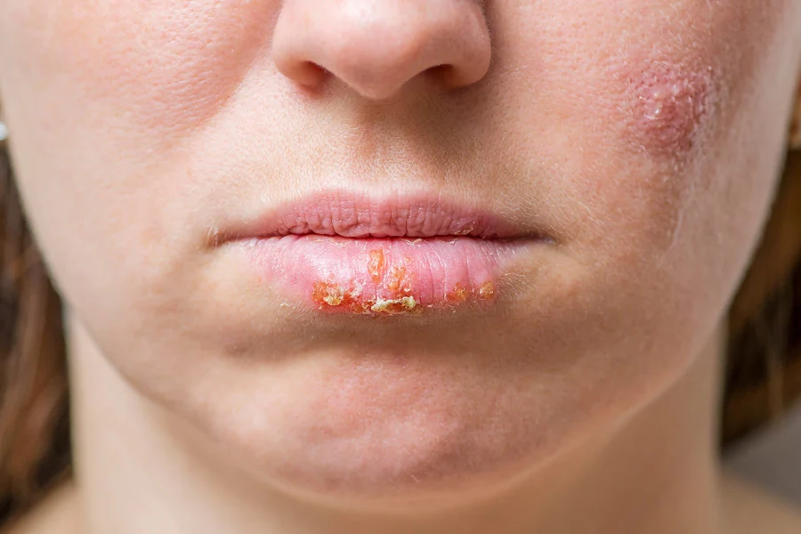 Lip Rash Treatment