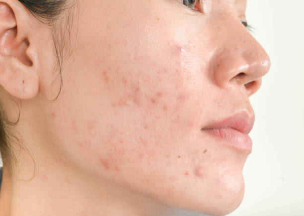 Can Laser Acne Scar Treatment Fix Rough Skin Texture