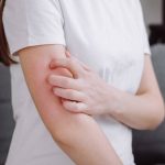 Does Eczema Treatment Help with Skin Burning