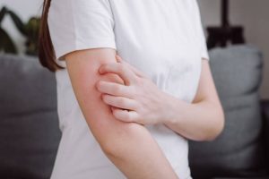 Does Eczema Treatment Help with Skin Burning