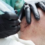 Scalp Micropigmentation in Abu Dhabi