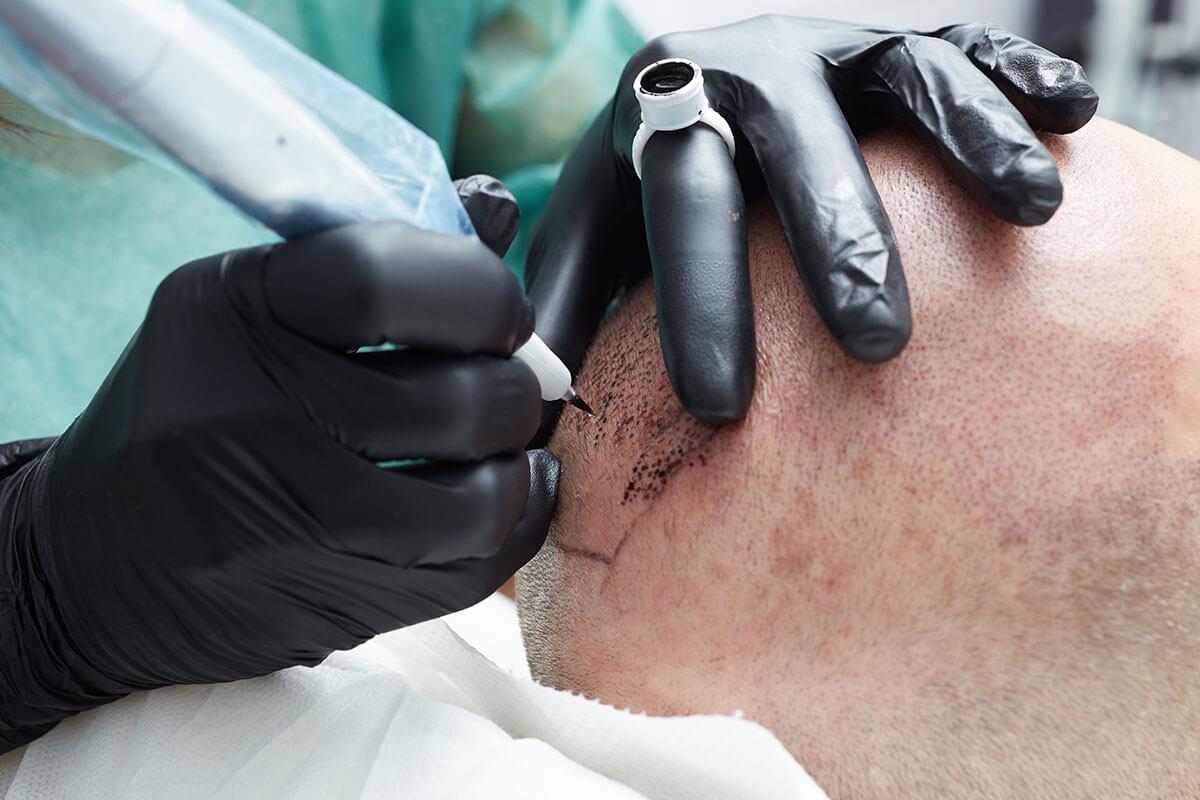 Scalp Micropigmentation in Abu Dhabi