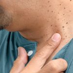 Skin Tag Removal in Abu Dhabi