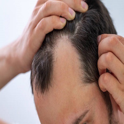 How Scalp Micropigmentation in Riyadh Is Transforming Hair Restoration