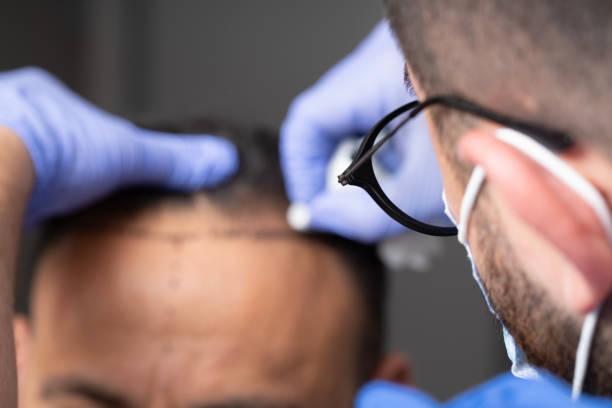 Hair Transplant in Riyadh