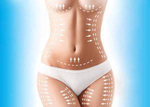 Can Liposuction Target Multiple Areas in One Session