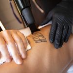 Can Tattoo Removal Reduce Dark Ink Visibility Fast?