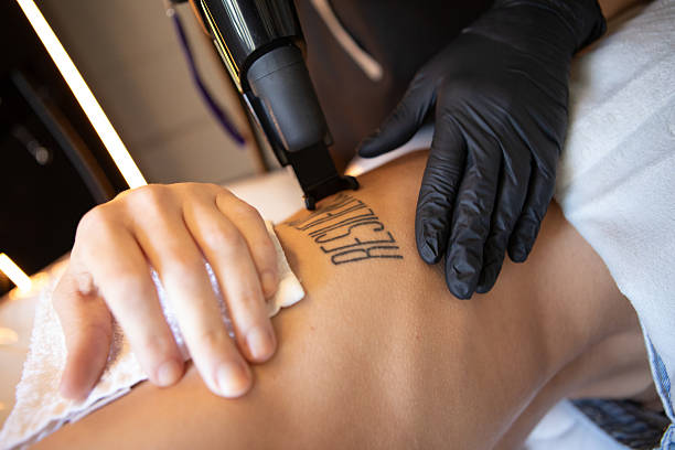 Can Tattoo Removal Reduce Dark Ink Visibility Fast?