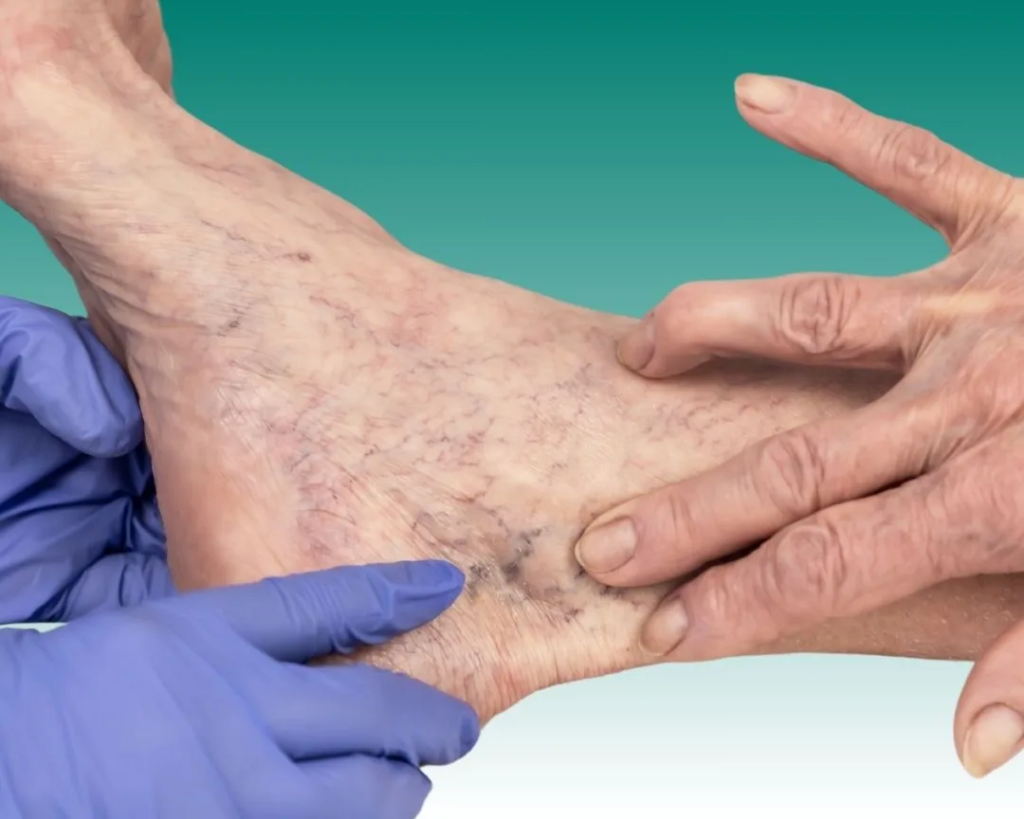 Sclerotherapy in Abu Dhabi