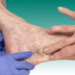 Sclerotherapy in Abu Dhabi