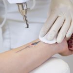 Smooth Clear Skin Through Tattoo Removal Treatments