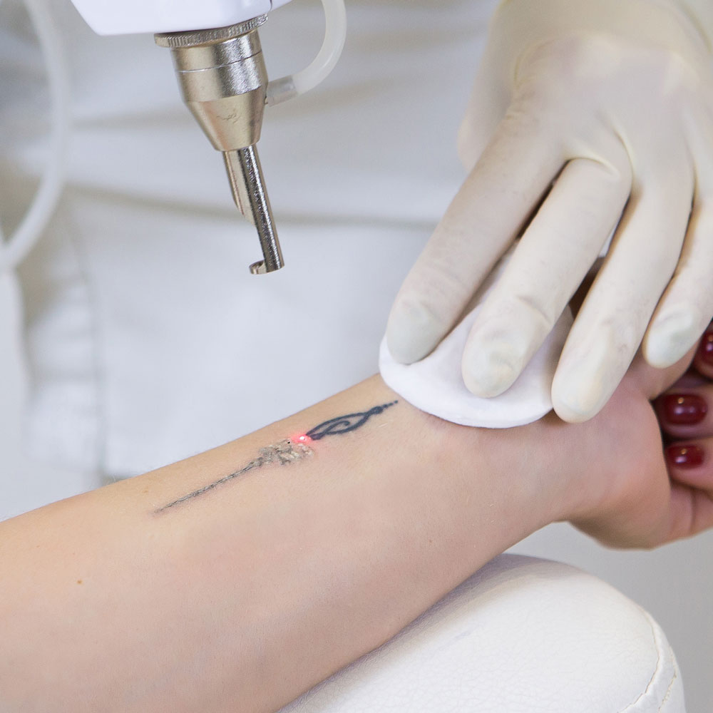 Smooth Clear Skin Through Tattoo Removal Treatments