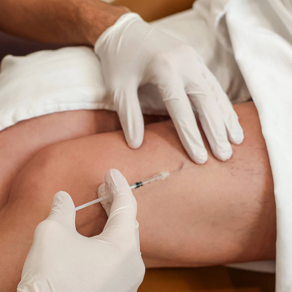 Smooth Legs Start Here with Expert Sclerotherapy Treatments