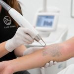 Tattoo Removal in Cape Town