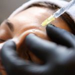 Botox injections in Dubai